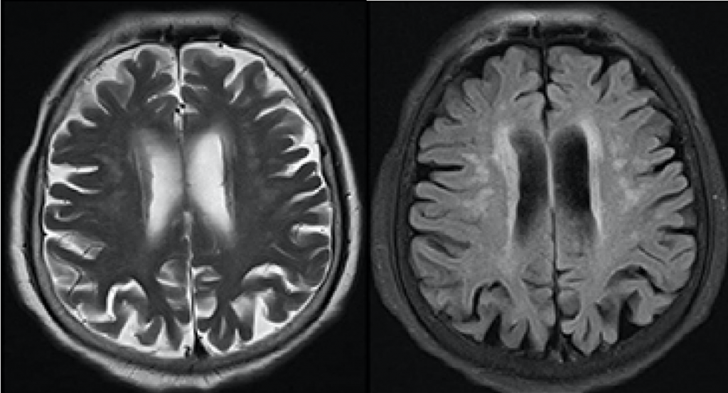 图1 慢性脑供血不足可导致脑白质损伤