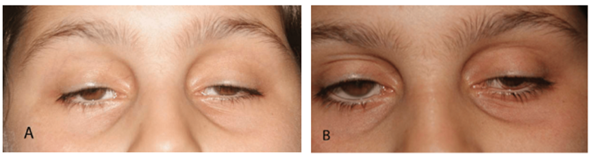 图2: 线粒体肌病导致的慢性进行性眼外肌瘫痪患者